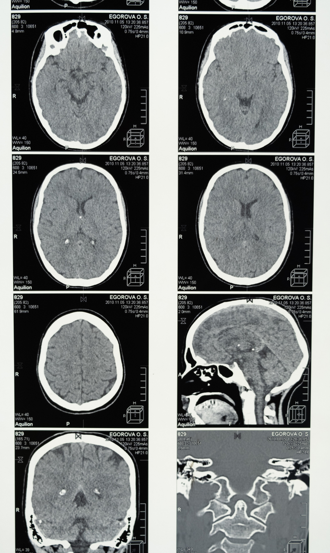 cerebro raio x